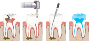 Root Canal Treatment Goolwa